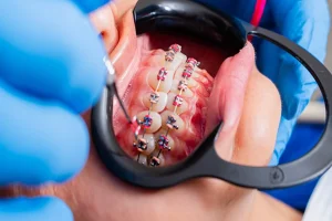 How Ceramic Braces Offer a Discreet Path to Aligned Teeth